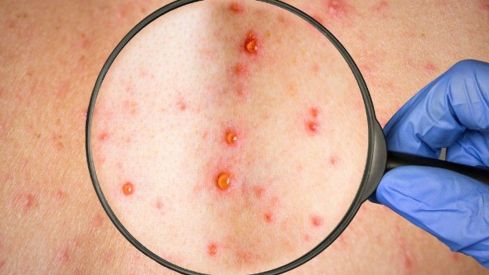 viruela-mono-oms-casos-confirmados