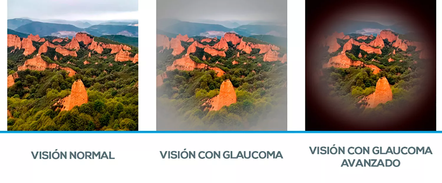 Imagen de la visión tras un glaucoma