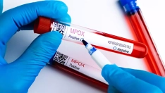 Analítica viruela del mono   Laboratorio