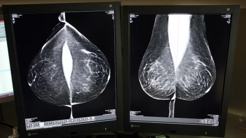 Sacyl externaliza la doble lectura de mamografías para agilizar los tiempos del cribado