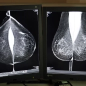 Sacyl externaliza la doble lectura de mamografías para agilizar los tiempos del cribado