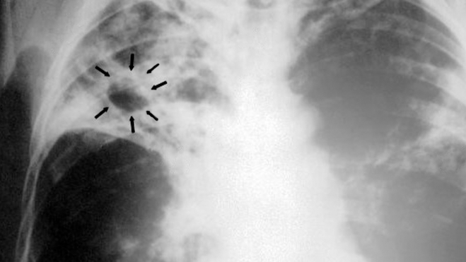 Tuberculosis con rayos X Tuberculosis con rayos X