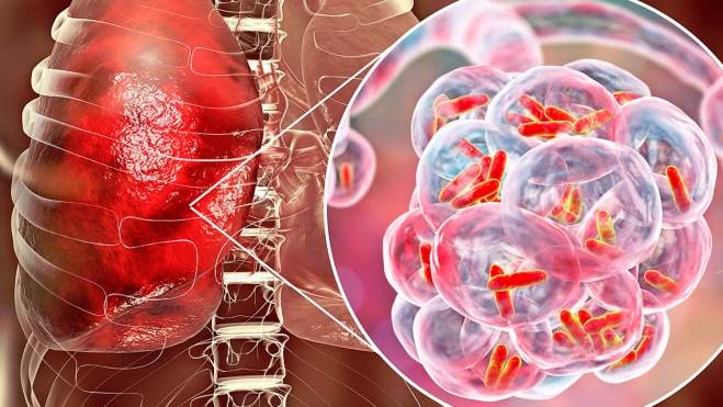 Tuberculosis Tuberculosis