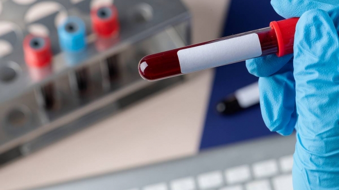 Un analisis genetico de sangre para una deteccion precoz del parkinson Un analisis genetico de sangre para una deteccion precoz del parkinson