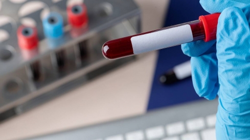 Un análisis genético de sangre para una detección precoz del Párkinson