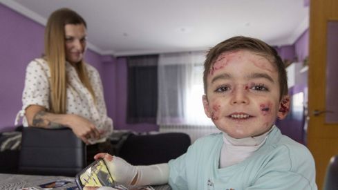 David Arranz / ICAL . El pequeño Javi Gallo, de seis años, convive desde su nacimiento con la enfermedad conocida como piel de mariposa. En la imagen con su madre, Carolina Gallo, en su casa.