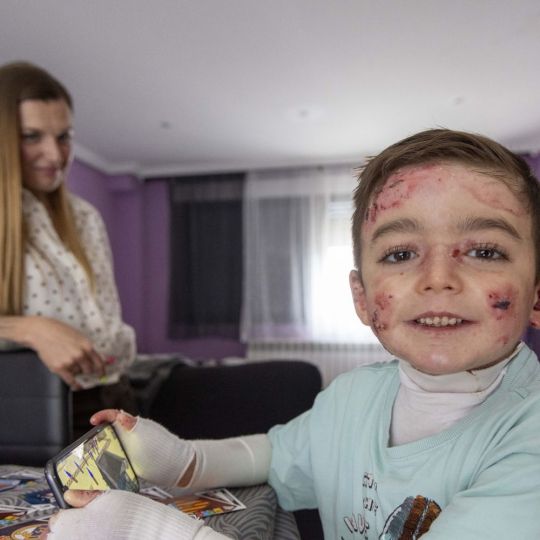 David Arranz / ICAL . El pequeño Javi Gallo, de seis años, convive desde su nacimiento con la enfermedad conocida como piel de mariposa. En la imagen con su madre, Carolina Gallo, en su casa.